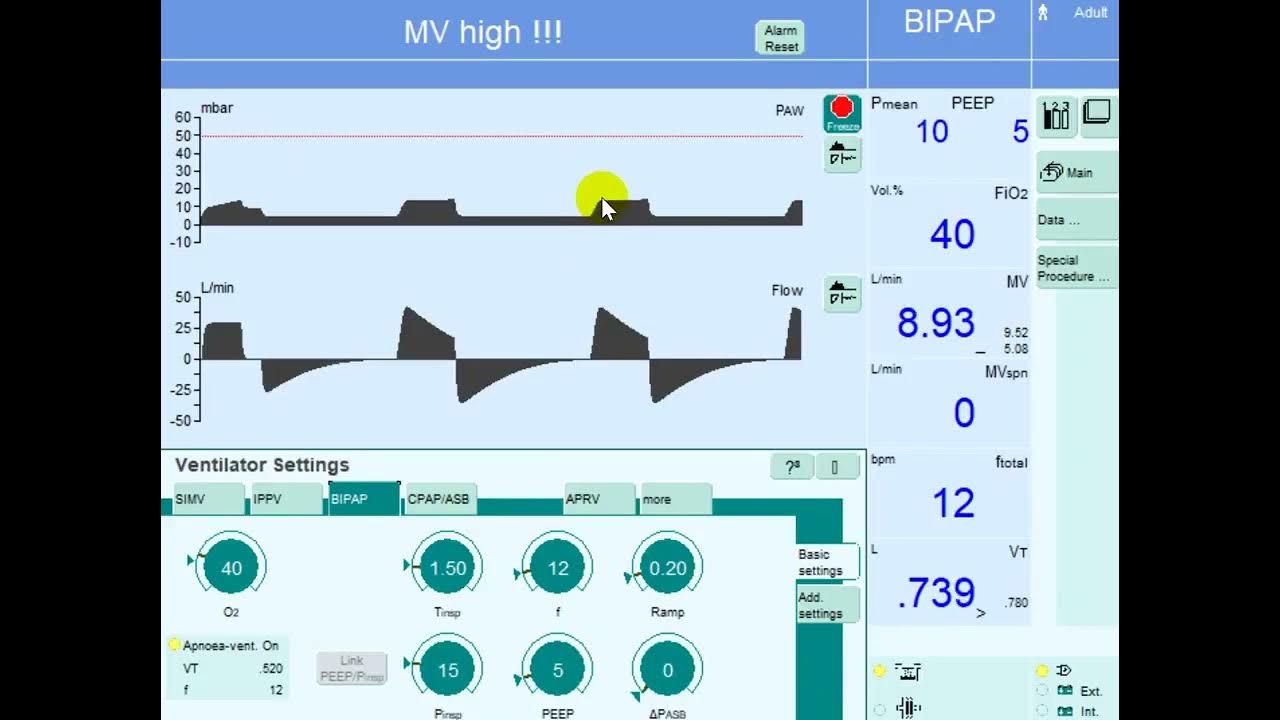Volume Control vs. Pressure Control on Mechanical Ventilation YouTube