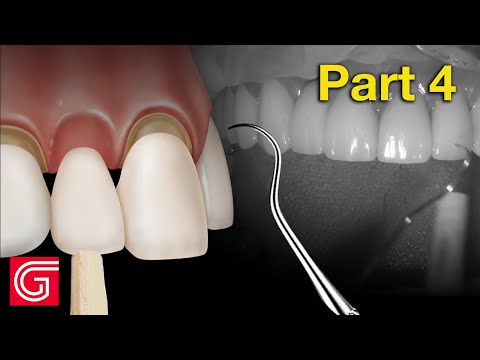 How To Try-In Zirconia Crowns Before Final Cementation