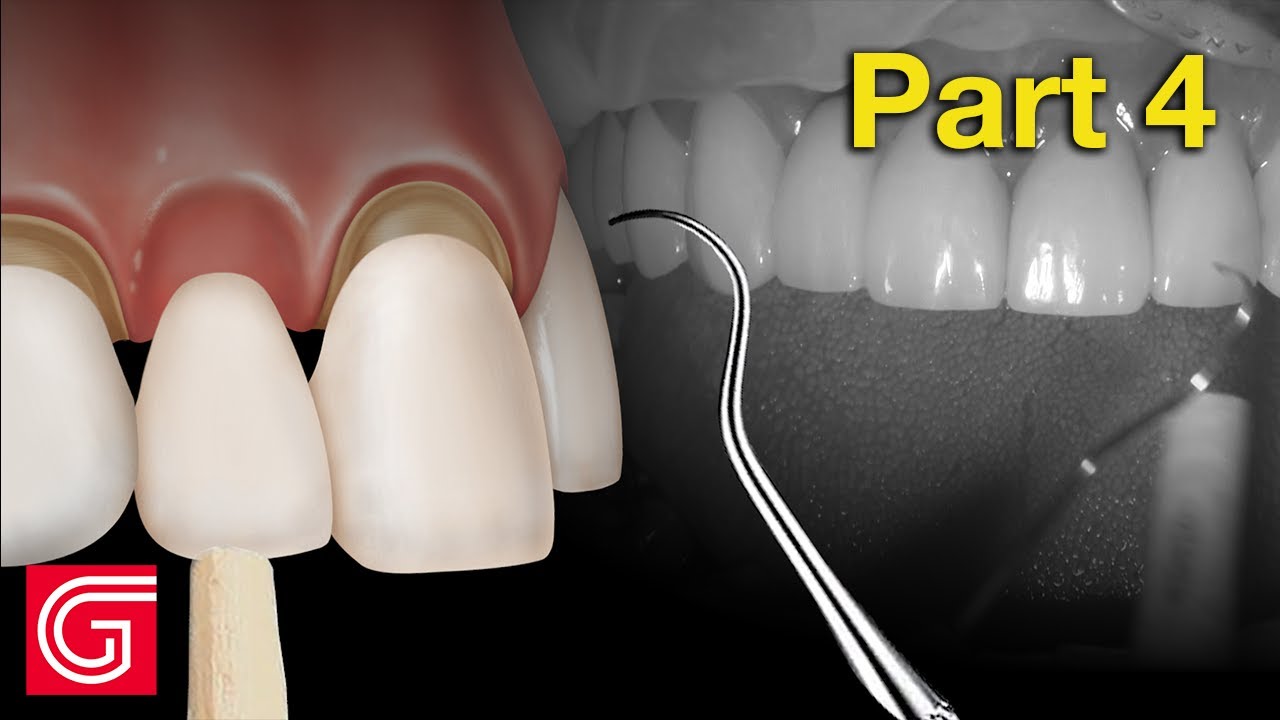 Cementing Zirconia Crowns at Flor Williams blog
