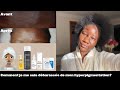 Ma routine soins de peau pour lutter contre lhyperpigmentation sur peau noire i rsultats 