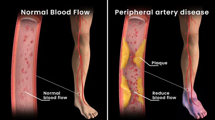Peripheral Artery Disease Angioplasty