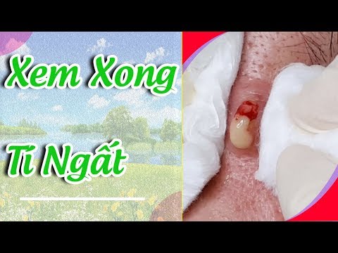 Cách điều trị mụn ẩn, mụn u nang hiệu quả. Tại Hiền Vân Spa - bài 145