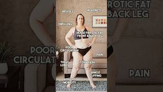 Evolução do lipedema 😮‍💨