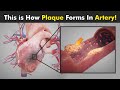 How Plaque Is Formed Inside Our Arteries? (Atherosclerosis)