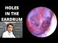 Double Eardrum Perforation Discovered After Dead Skin Removal