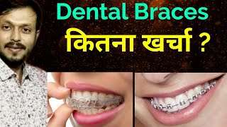 How much Braces Cost in India | Dental Braces | Dental Braces price in Hindi |