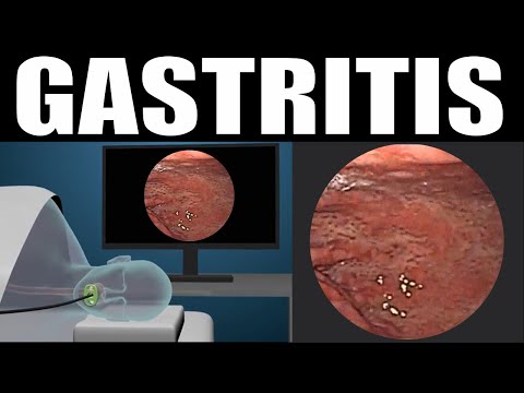 Vídeo: Gastrite - Tipos, Sintomas, Tratamento, Dieta