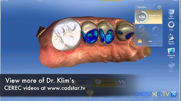 CEREC Biogeneric Variation Tool Application