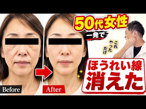 【ほうれい線・ブルドッグ顔解消】50代女性のほうれい線・顔のたるみ・マリオネットラインが一瞬で消えたマッサージ1回やってみて！