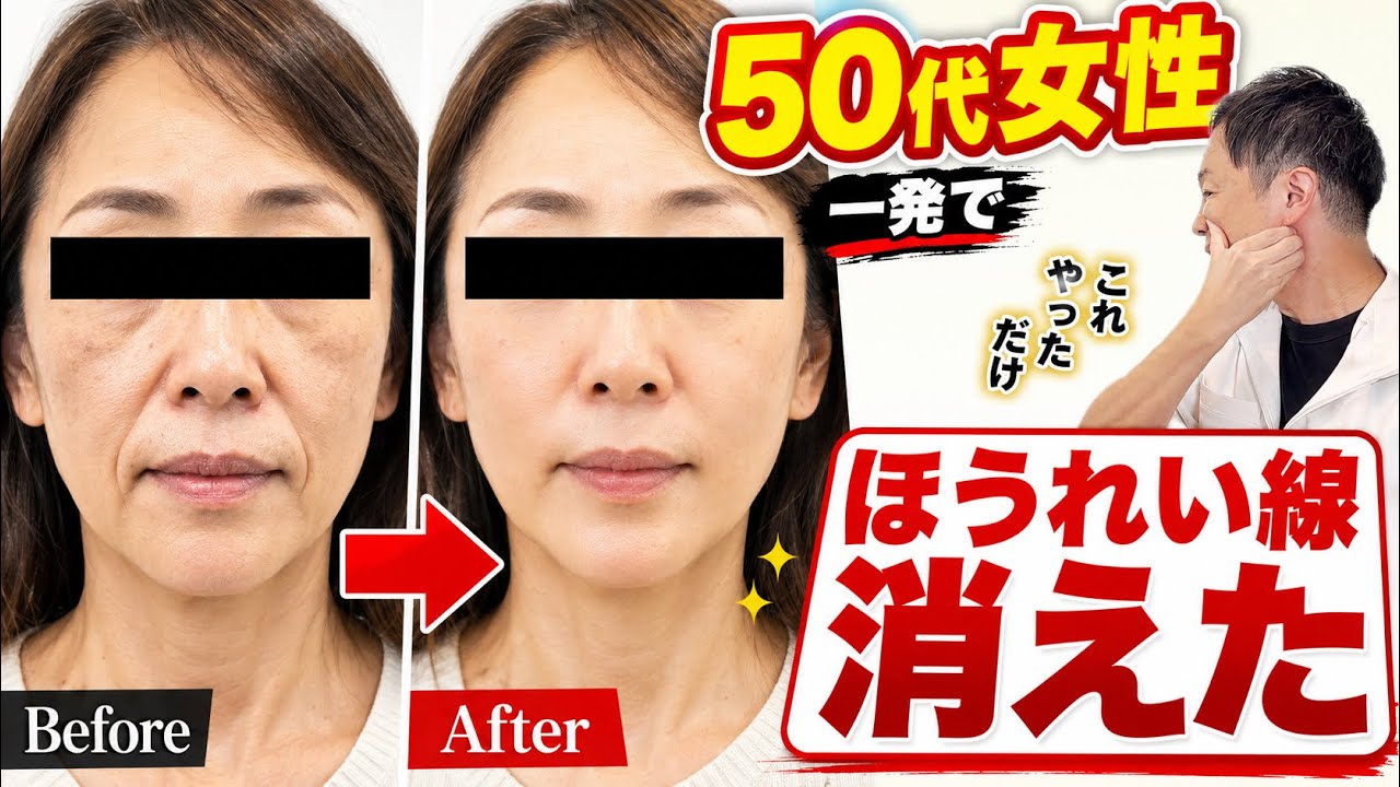 ほうれい線・ブルドッグ顔解消】50代女性のほうれい線・顔のたるみ