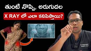 Have Hip pain | Hip Arthritis X-Rays Explained: A Simple Guide for Patients | Dr Ramprasad K