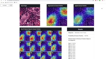 Lymph Node Cancer Detection with AI