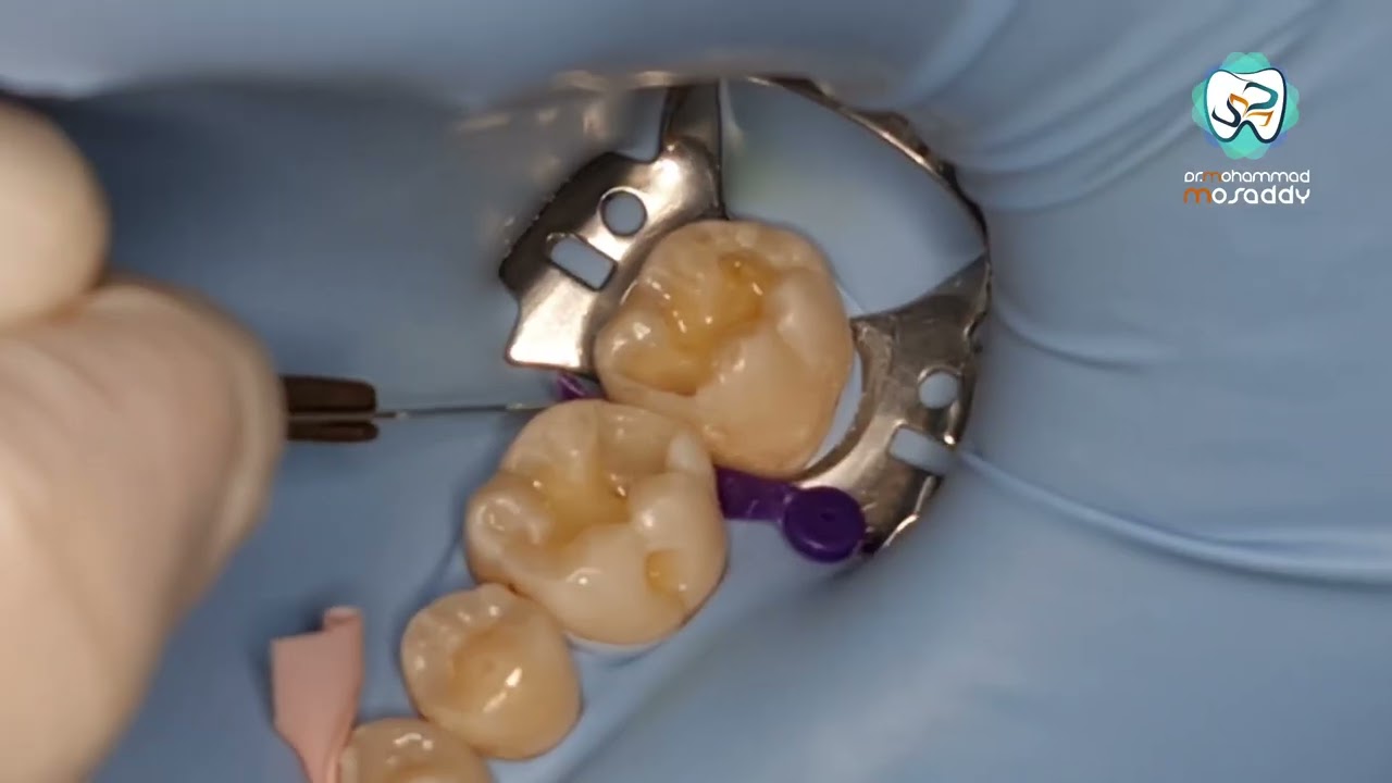 كيف بتتعامل مع حشوات كومبوزيت class 2