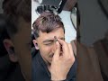 ازالة الحباية المتسلطنة من بين الحاجب      
