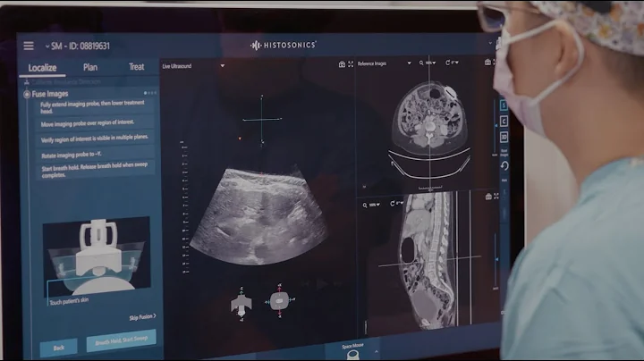 Histotripsy: Treating Cancer with Sound Waves