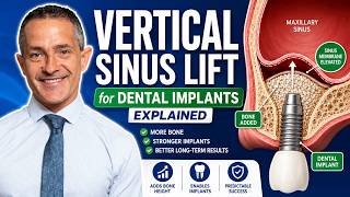 Vertical Sinus Lift Explained | Bone Grafting for Dental Implants | New Jersey Implant Dentist