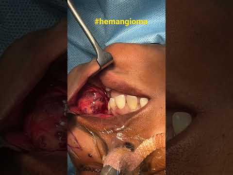 Surgical Miracle - A Huge Blood Filled Tumor Hemangioma is Removed without any blood loss!