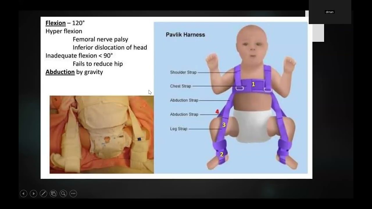 DDH Part 1: Definitn, etio-pathogenesis, natural history, C/F, radiology: Dr. Nandhini Iyer