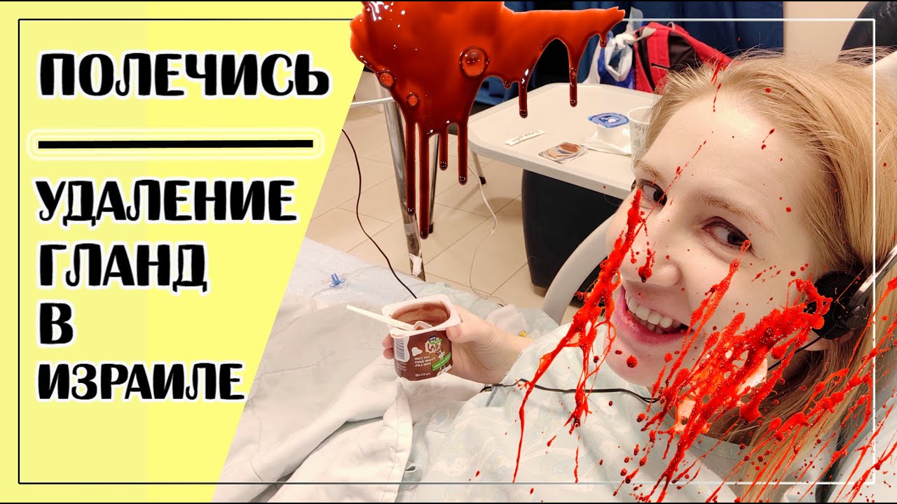 Тонзиллотомия в Ассуте (Тель-авив) - YouTube