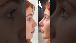 Beautiful nose transformation with fillers with Kiran at Deep Aesthetics #nosefiller #beauty #filler