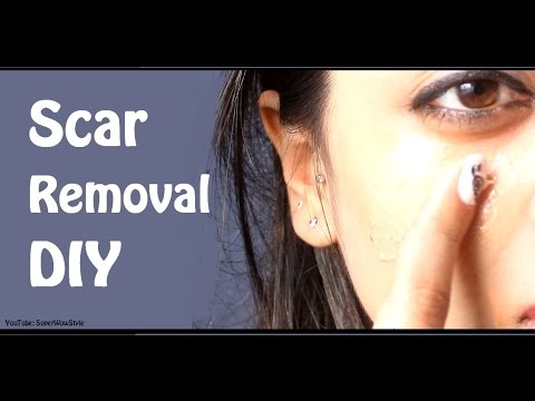 Fade Away Acne Scars  - (CLEAR SKIN!) | by SuperWowStyle Prachi