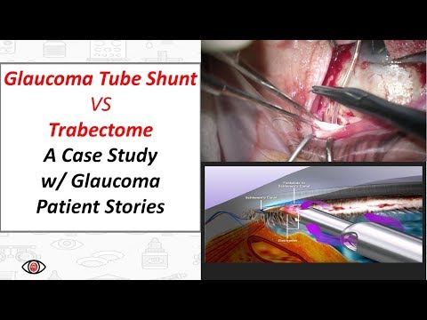 Glaucoma Tube Shunt vs Trabectome Goniotomy A Case Study with Glaucoma Patient Stories