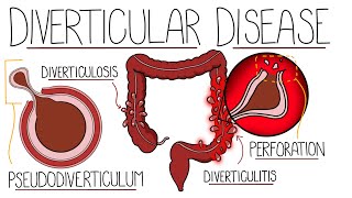 Understanding Diverticular Disease (Diverticulosis vs Diverticulitis) by Rhesus Medicine 6,721 views 5 months ago 6 minutes, 50 seconds