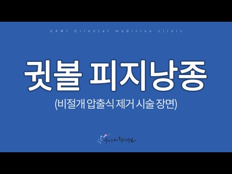 170214_ê·“ë³¼ ì—¼ì¦ Cyst extraction without pain, surgery and scar/ çš®è„‚å›Šè‚¿æ²¡æœ‰æ‰‹æœ¯æŒ¤åŽ‹æŽ’é™¤