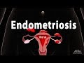 Endometriosis: Pathology, Symptoms, Risk factors, Diagnosis and Treatment, Animation