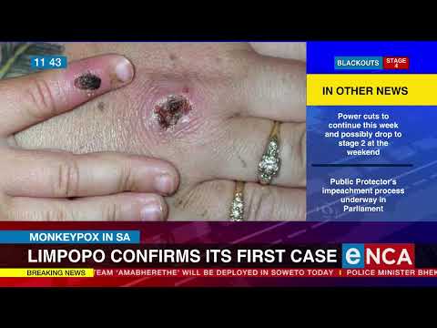 Monkeypox in SA | Limpopo confirms first case