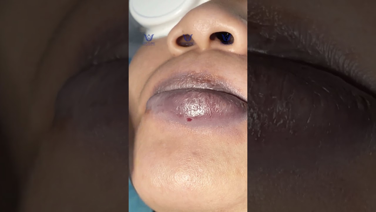 Nặn mụn mủ viêm to ở Môi.