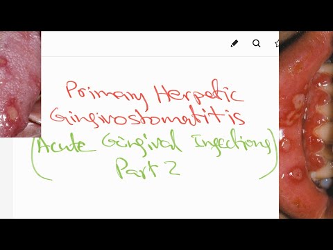 Video: Herpetisk Stomatitis - Behandling, Symptomer Og Former