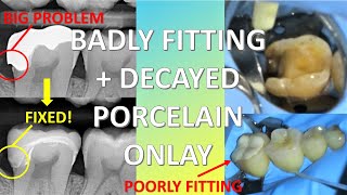 Extremely Difficult Ceramic Onlay Replacement With Emax Using CEREC | Indirect Case #1 by Dr Paul's Dental World 3,535 views 2 years ago 14 minutes, 57 seconds