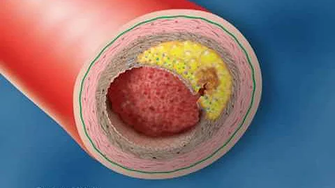 Vulnerable Plaque Rupture - Medical Animation by Watermark - DayDayNews