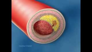 Vulnerable Plaque Rupture - Medical Animation by Watermark screenshot 1