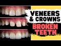 Teeth Bonding vs Porcelain Veneers vs Tooth Crown | Broken Tooth Repair