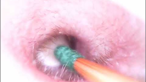 为什么要洗耳?/油腻的耳垢该如何解决?/油耳/湿耳/洗耳/采耳掏耳屎（恶心下酒菜系列）采耳丘－苗栗专业掏耳 Chu Ears - 天天要闻
