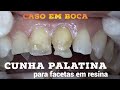 🔥FACETAS EM RESINA: Segredo para realizar CUNHA PALATINA A MÃOS LIVRES EM BOCA🔥🔥🔥