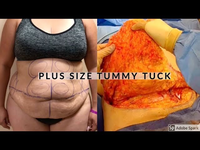 Plus Size Tummy Tuck+ Back Liposuction - Dr Repta Plastic Surgery 