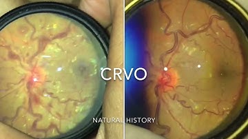 CRVO natural history of vessel tortuosity and haemorrhages - Central Retinal Vein Occlusion Fundus