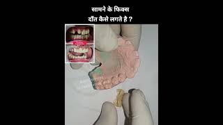 सामने के फिक्स दाँत कैसे लगाए जाते है ?Zirconia Bridge #shorts