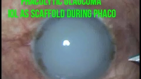 Phacolytic Glaucoma - Hydrophyllic IOL as Scaffold during Phaco