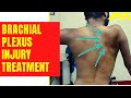 How to start exercises in brachial plexus injury in hindi       