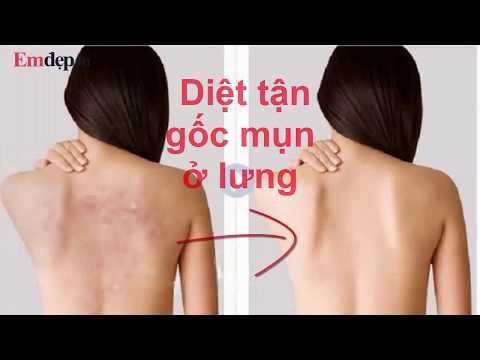 Trị mụn lưng - để có 1 tấm lưng trần thật đẹp