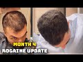 4 Month Rogaine Update (Minoxidil) - IS MY HAIR COMING BACK!?