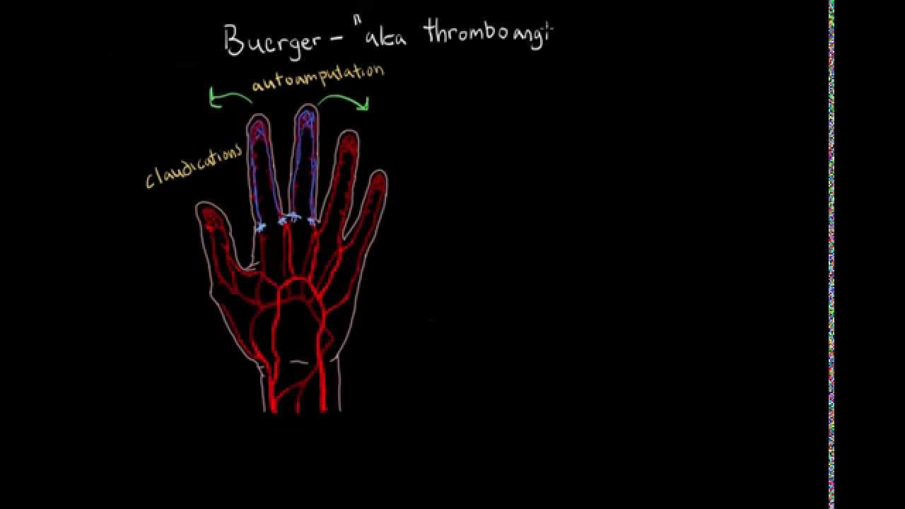 Buerger Disease YouTube
