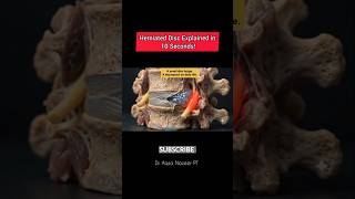 Herniated Disc Explained in 10 Seconds! #shorts #viral #trending #physiotherapy