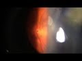 Eye floater - Weiss ring