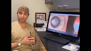 What if I have Cataracts with Corneal Scars? Combination Cataract Surgery to GulaniVision!
