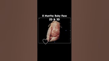 2D & 3D Baby Face at 8 Months #jerbearimaging #athomeultrasound #babyface #ultrasound #2Dand3D